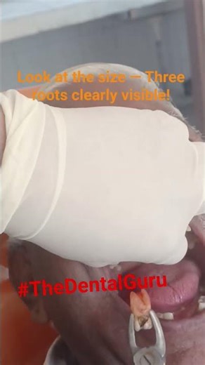 UpperMolar Extraction Painlessly Three Rooted Tooth Removed in Seconds#बिना दर्द दांत #TheDentalGuru
