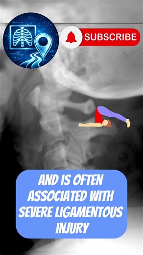 This Small Neck Fracture Is Extremely Dangerous #radiology #neuroradiology