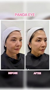 217 reactions · 14 shares | Say goodbye to tired, dark under-eyes! ✨The Aivee Panda Eye Treatment at @theaiveeclinic is the ultimate game-changer for brighter, refreshed eyes. No filters needed! It’s no wonder everyone is obsessed, including @catarambulo, who can’t stop raving about the instant results. No surgery, just a fresh, well-rested glow!♥️ | Aivee Aguilar Teo | Facebook