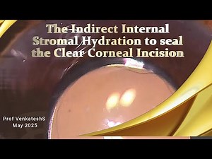 The Indirect Internal Stromal Hydration to seal The Clear Corneal Incision.