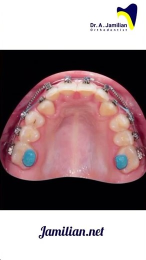 Treatment of Impacted Upper Canines: Surgical Exposure and Orthodontic Traction #impaction #brace