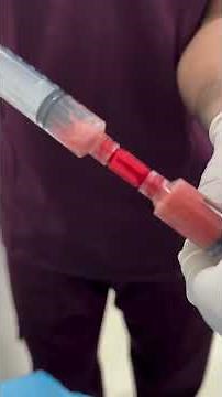 Fat Transfer To Fill Acne Scars #dranvika #cosmeticdermatology #acnescar #fattransfer