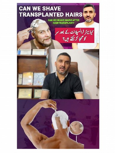 Can You Shave After a Hair Transplant? Expert Insights by Dr. Habib