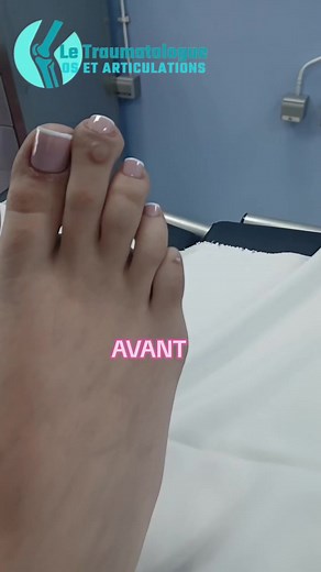 Chirurgie des orteils : Rétablissement du confort