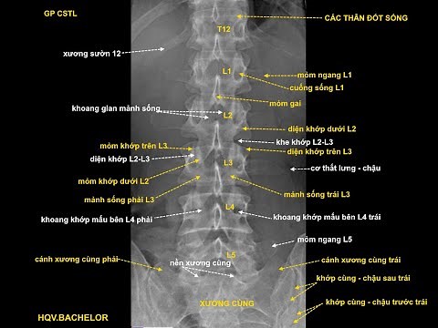 X quang cột sống thắt lưng thẳng
