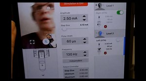 DBS programming guided by a shaky videoframe