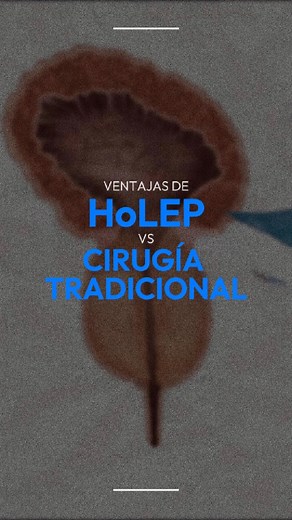 HOLEP vs. Cirugía Tradicional: lo que debes saber Ambos procedimientos se utilizan para tratar la hiperplasia prostática benigna (HPB), pero existen diferencias clave: 🎥 Te cuento este reel.👆🏼 👨‍⚕️ Soy el Dr. Daniel González, urólogo especializado. 📞3323436921 📍Hospital San Javier, Torre 2, Consultorio 629 ▪️UAG 10443903 UDG 13921344 ▪️COFEPRIS 2414102002A00030 | Dr. Daniel González Urólogo