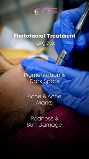 Dull Skin to Glowing Skin ✨ | Photofacial Treatment by Dr. Megha Modi#photofacial