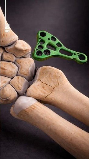 How surgeons fix a broken wrist