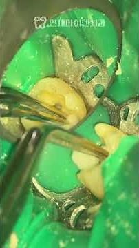 Vital Pulp Therapy Treatment Process