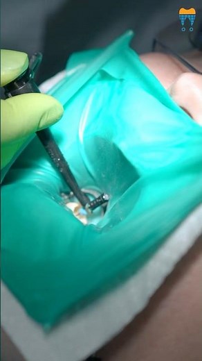 Endo Motor vs Rotary Files⚡Which One is the Game-Changer? 🤯🦷 #shorts