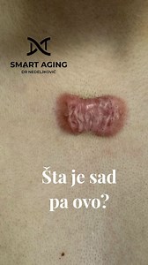 ‼️KELOID – kada ožiljak „ne zna da stane“ Keloid je patološki ožiljak koji nastaje kada proces zarastanja rane izmakne kontroli. Umesto da se formira tanak, diskretan ožiljak, koža nastavlja da proizvodi kolagen – previše i predugo. 🔬 Kako nastaje keloid? Nakon povrede kože, a kod genetski predisponiranih osoba dolazi do: 1.prekomerne aktivacije fibroblasta 2.nekontrolisane sinteze kolagena tipa III 3.pojačanja lokalnih faktora rasta (TGF-β, PDGF) 4.širenja ožiljka izvan granica originalne rane