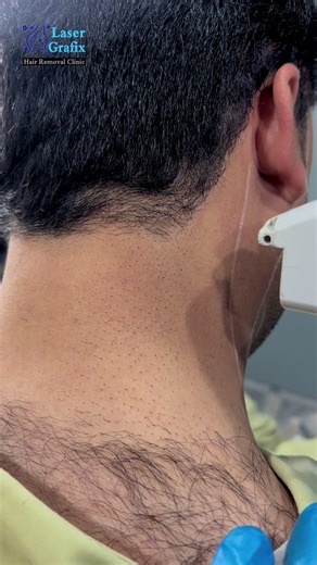 Candelalaser Hair Removal Process Explained