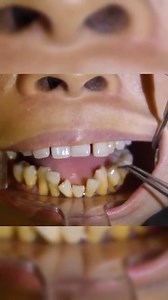 523K views · 1.9K reactions | All His Teeth Wiggle?! 醴浪 - - Make sure to check out our oral care company that gives back! @thesomethingniceco ❤️瘟醴 Get your Waterflossers while you can!  The world famous floss picks are also still in stock!  - - - #reels #teeth #dentistry #braces #health #reaction | TheBentistofficial | Facebook