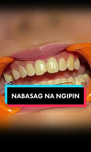 Chipped Tooth Treatment: Expert Tips and Solutions