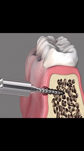 A mini screw is a very small screw/pin that attach into the jaw which is then connected to the tooth to help move the teeth🦷💉 . . . . . . . #tiktok #love #like #follow #explore #2023 #meme #orthodontics #orthodontist #duet #repost #miniscrew #sundayfunday #tiktokfamous #tiktoktrend #viralvideos #viralpost #dental #dentist #dentistry #shqipe #dentalimplants #learnontiktok #fypシ #foryoupage #fypシ゚viral #learnontiktok #braces #shqipnia #kosova