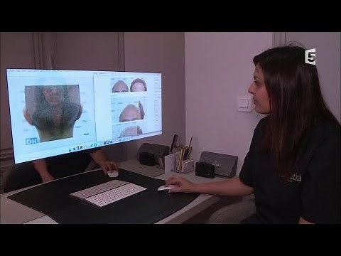 Hair implants: are they worth it?