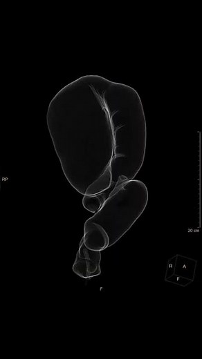 Sigmoid volvulus - virtual colonoscopy
