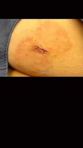 Marble Cyst | Dr. Pimple Popper #drpimplepopper #shorts #pimplepopper #youtube