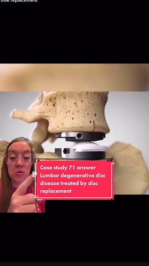 Case study 71 - lumbar degenerative disc disease treated with lumbar disc replacement 🎥: @Betsy Grunch, M.D. 🧠 A lumbar disc replacement is a type of back or spine surgery. Your spine is made up of bones called vertebrae that are stacked on top of each other. Discs between the vertebrae work like cushions to allow the vertebrae to rotate and move without the bones rubbing against each other. The lumbar vertebrae and disc are at the bottom of your spine. Lumbar disc replacement involves replaci