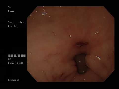 Endoscopic Therapy for Bleeding Gastric Ulcer