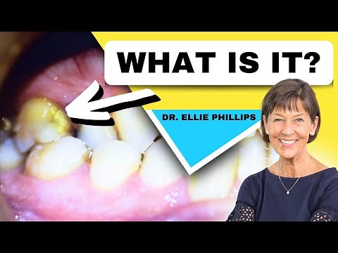 What is Dental Plaque? (How to Prevent More From Forming)