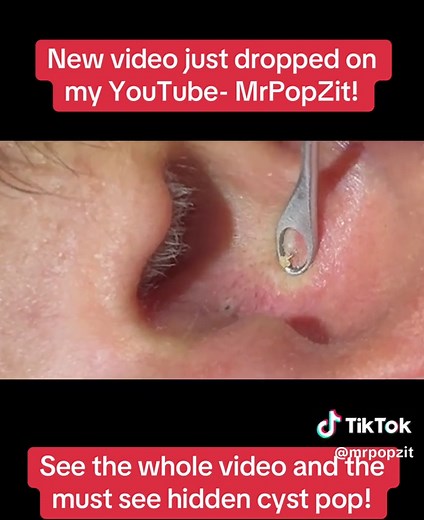 Watch me clear out his ears and find a deep, explosive, hidden cyst at the end! See the entire video on my YouTube channel- MrPopZit #mpzdermatology #mrpopzit #dermatology #blackhead #acne