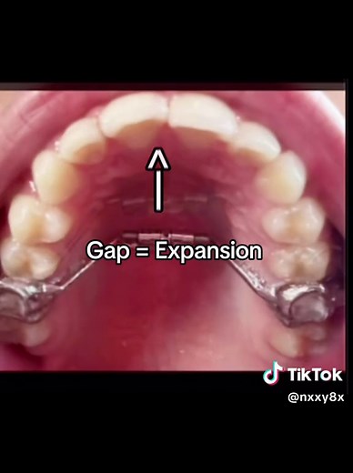 Transforming Smiles: The Benefits of Palate Expansion