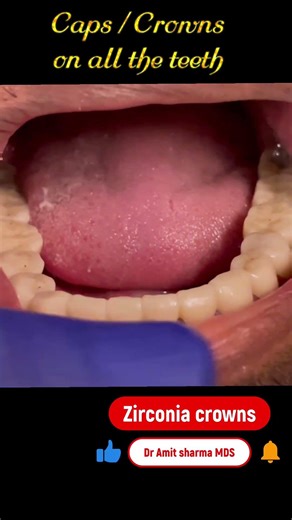 Caps / crowns placed on all lower teeth