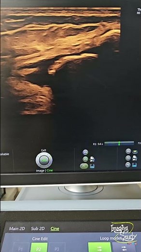 Suprapatellar Calcific Bursitis || Ultrasound