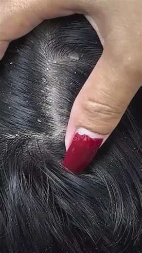 Scratching BIG Dandruff Flakes Before Hair Wash