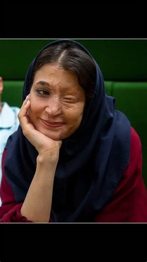 OSAGIE ERO | The face of courage, strength and beauty: acid attack survivor Marzieh Ebrahimi in Iran. They tried to silence her with acid. She answered... | Instagram