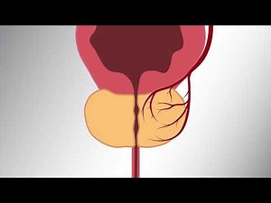 Prostatic Artery Embolization (PAE) Patient Video