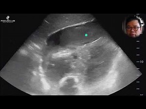 eFAST or eFAIL - How to do the eFAST POCUS exam?