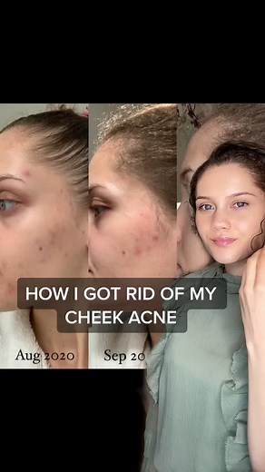 How to Get Rid of Cheek Acne: Tips and Solutions
