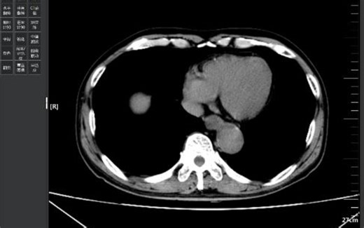 1.5T 胰胆管磁共振水成像（MRCP）