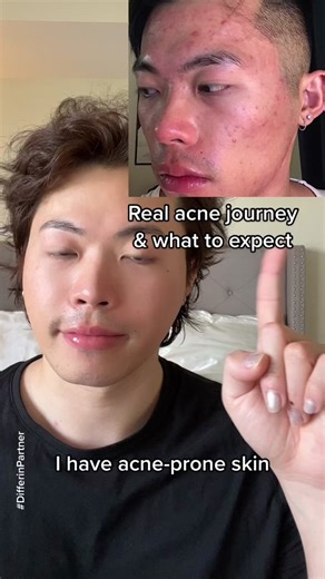 I will always recommend @differinus Gel to heal and prevent future acne. Acne treatment takes time. Stay consistent and achieve your clear skin goal. Ask me anything:) #DifferinPartner #DifferinAcneJourney #acnetransformation #clearskintips #skincaretipsforyou #adapalene #unclogpores #pores #adultacne #teenacne