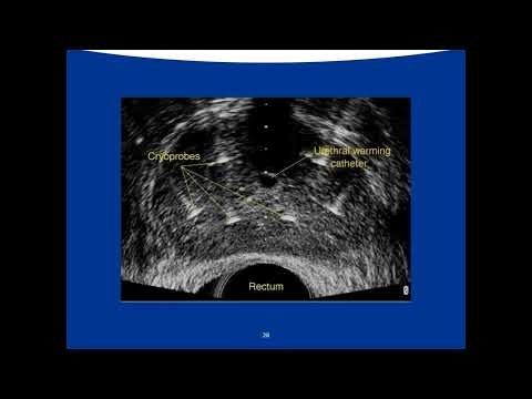 Cryotherapy for Prostate Cancer - Dr. Kenneth Kernen | ForTec Medical