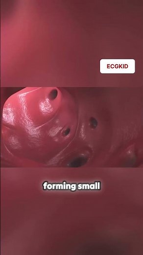 Diverticulitis explained! 3D animation #medicaleducation #guthealth #doctor