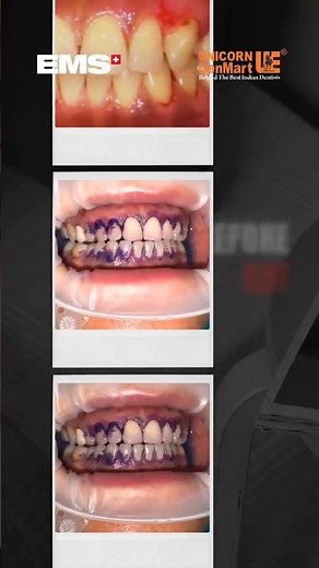 Deliver Painless, Precise & Prophylaxis With Guided Biofilm Therapy!