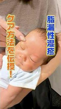 脂漏性湿疹、放置して大丈夫？ #shorts #脂漏性湿疹 #生後2ヶ月 #生後1ヶ月 #赤ちゃんケア方法