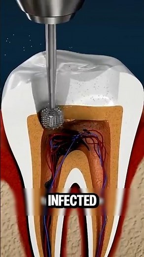 Why Do Dentists Remove the Nerve From Your Tooth? 🦷😲 #medicalfacts