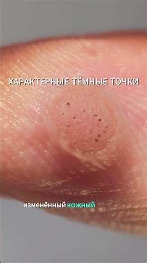 Бородавка на пальце: как отличить от мозоли