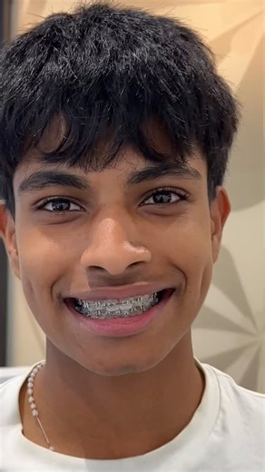 When your smile looks amazing but there’s something special hidden behind the scenes! 👀 Those tiny white “turbos” behind his upper front teeth are bite planes which are clever little helpers that keep deep bites from closing too far. They protect the lower braces and gums , while gently guiding the back teeth to erupt into the perfect position. It’s precision, comfort, and science all working together for a healthier, more balanced smile 😁 Expertly designed care by Dr Daxter Yeo, Orthosmile Or