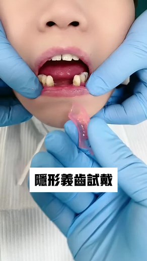 #微笑牙 #牙齒 #牙貼片#全瓷牙 #牙齒美學