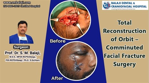 Total Reconstruction of Orbit – Comminuted Facial Fracture Surgery | Balaji SM