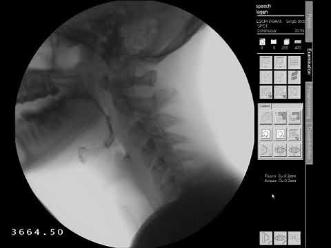 Swallow Study - 13 mm Barium Tablet/Pill - Modified Barium Swallow Study (MBSS) Lateral View HD