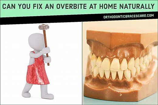 Can You Fix An Overbite At Home Naturally - Orthodontic Braces Care