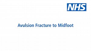 NHS Virtual Fracture Clinic - Avulsion Fracture to Midfoot