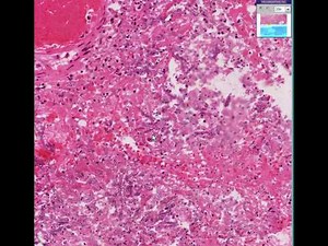 Histopathology Lung--Aspergillosis